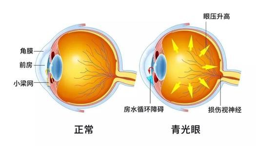 青光51.jpg 青光51.jpg