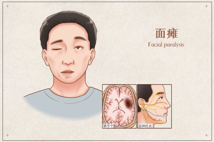 摄图网_401863680_面瘫医疗插画（非企业商用）.jpg